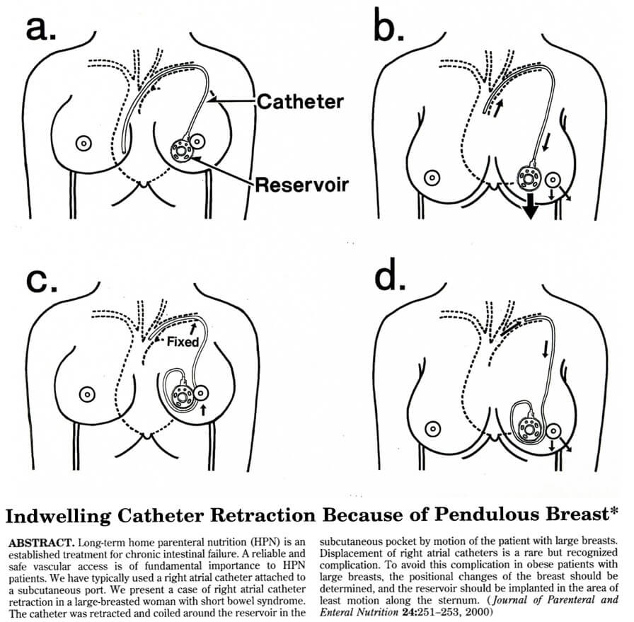 Indwelling Catheter Retraction